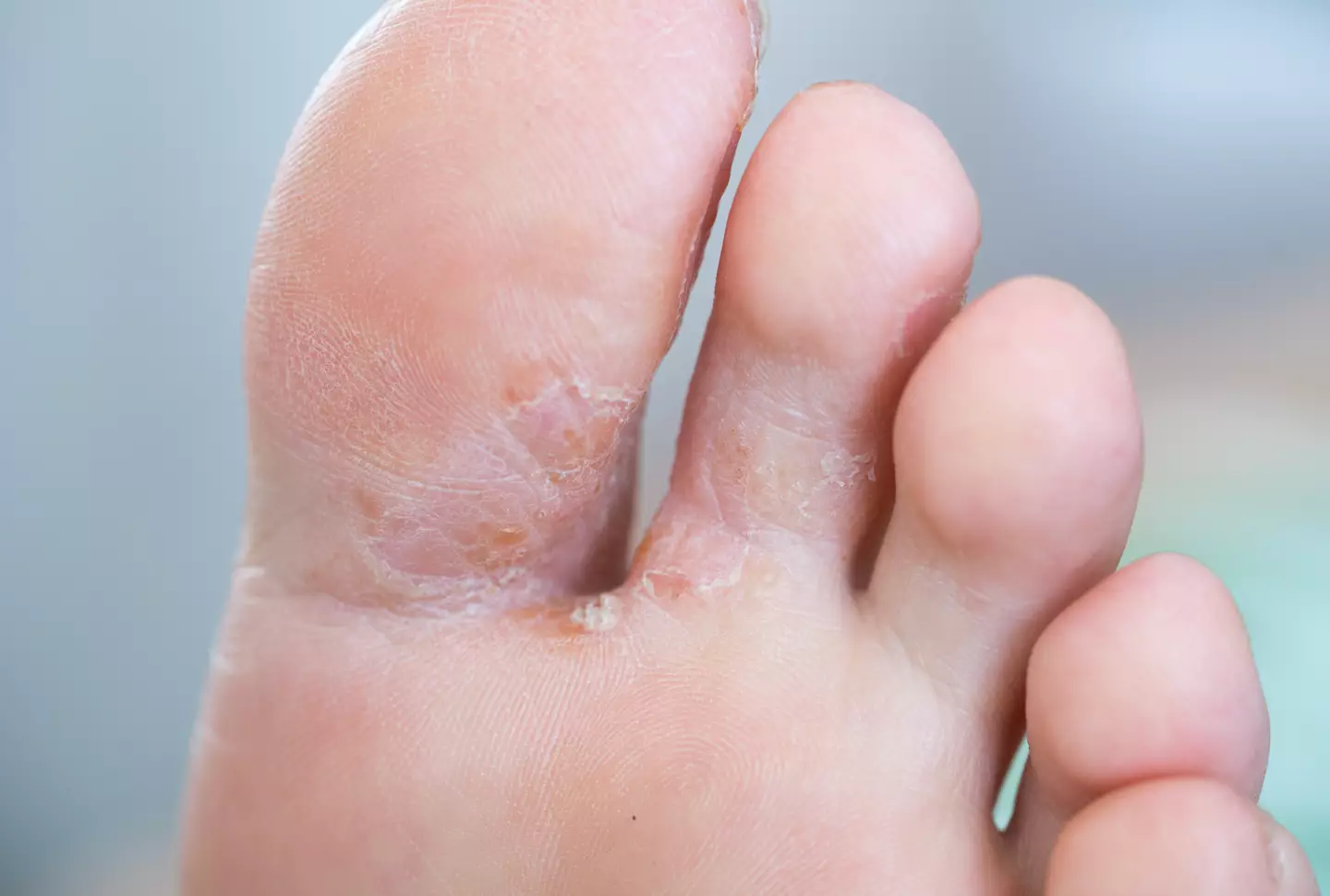 Athlete's foot is a contagious fungal infection (Getty Stock Image)