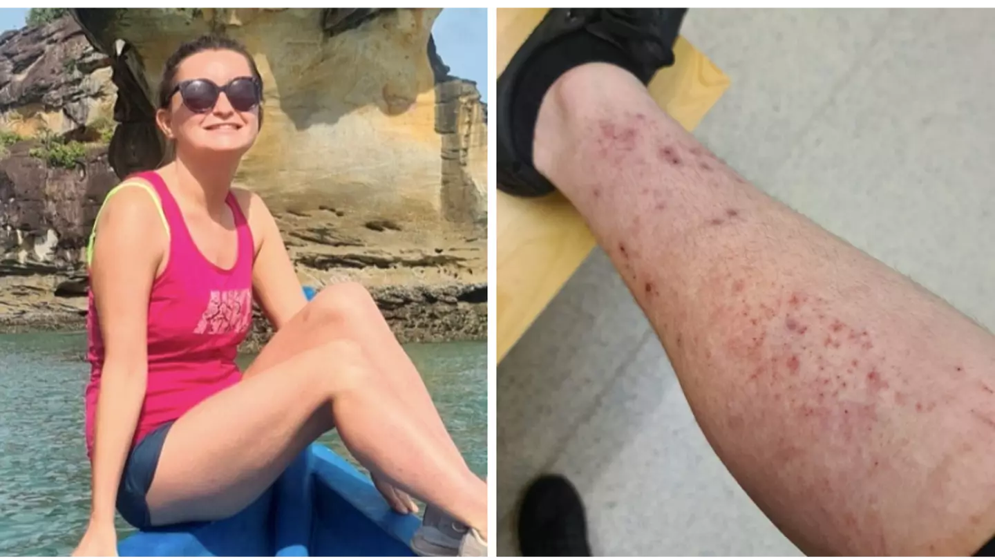 Woman says miracle drug cured eczema that left her bed bound for decades