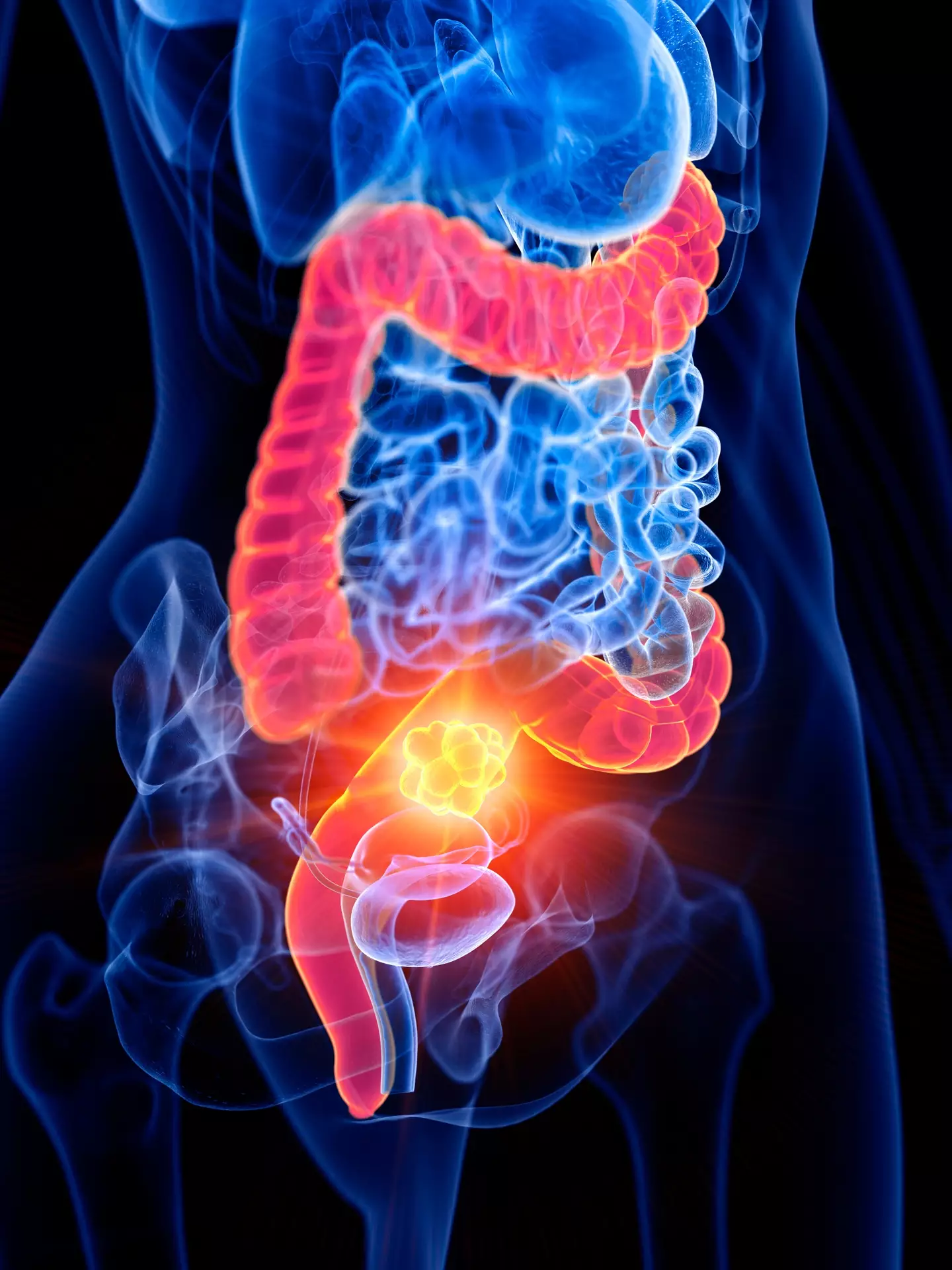 Those suffering from major bowel cancer symptoms should book in with a medical expert ASAP (Getty Stock Image)