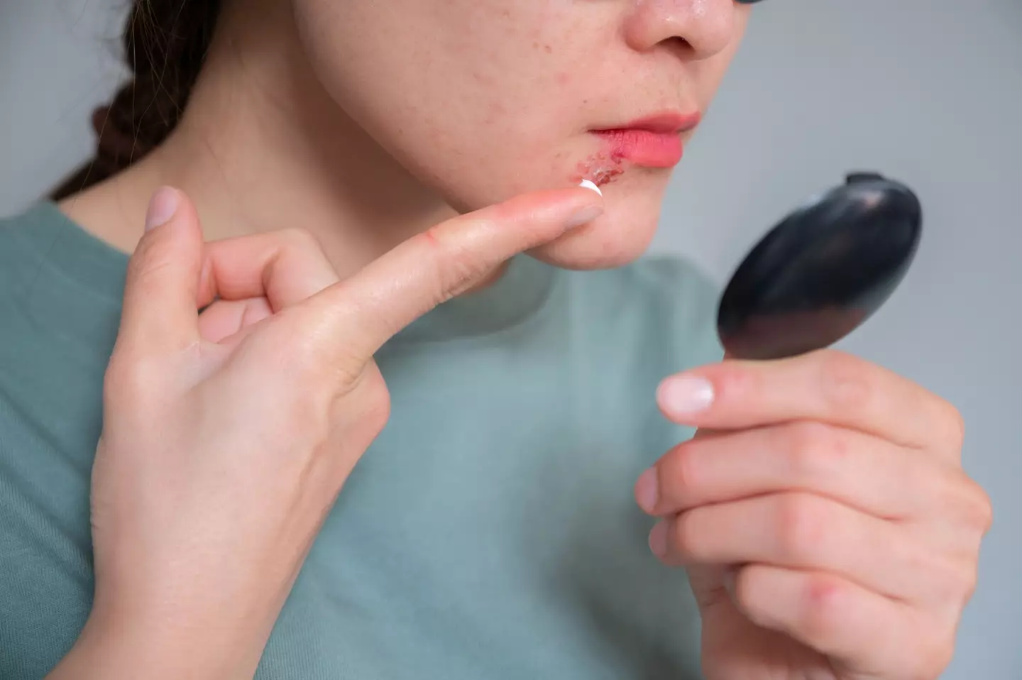 The virus that causes cold sores may also be linked to Alzheimer's (Getty Stock Image)