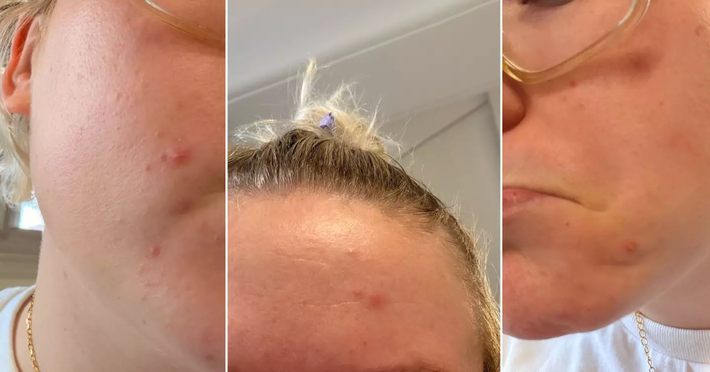 The spots were an unexpected side-effect of going vape free.