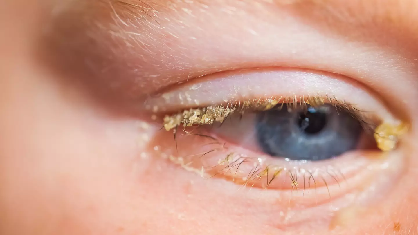 People disturbed after realising what yellow stuff in your eyes when you wake up actually is