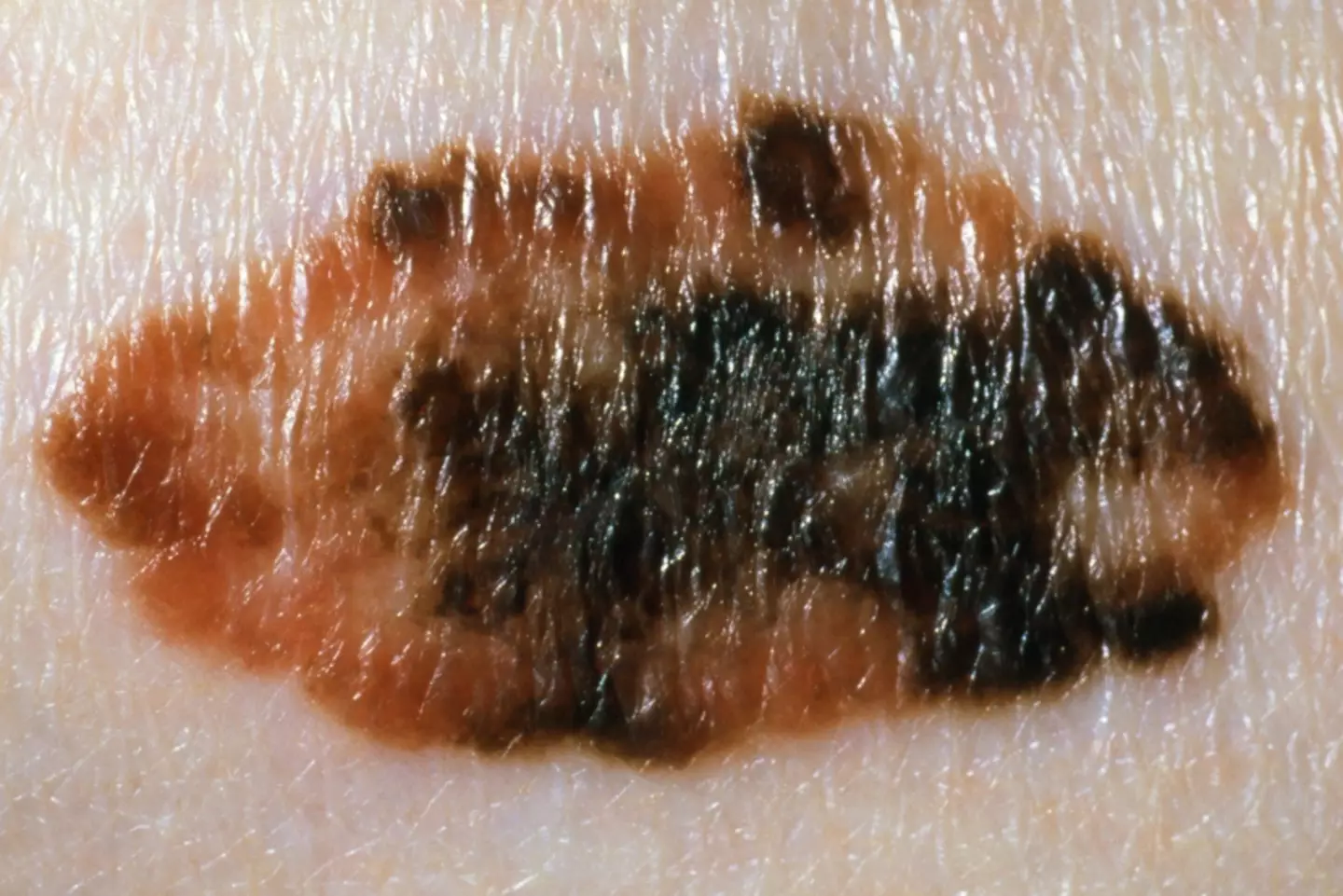 Moles are usually only one colour. (NHS)
