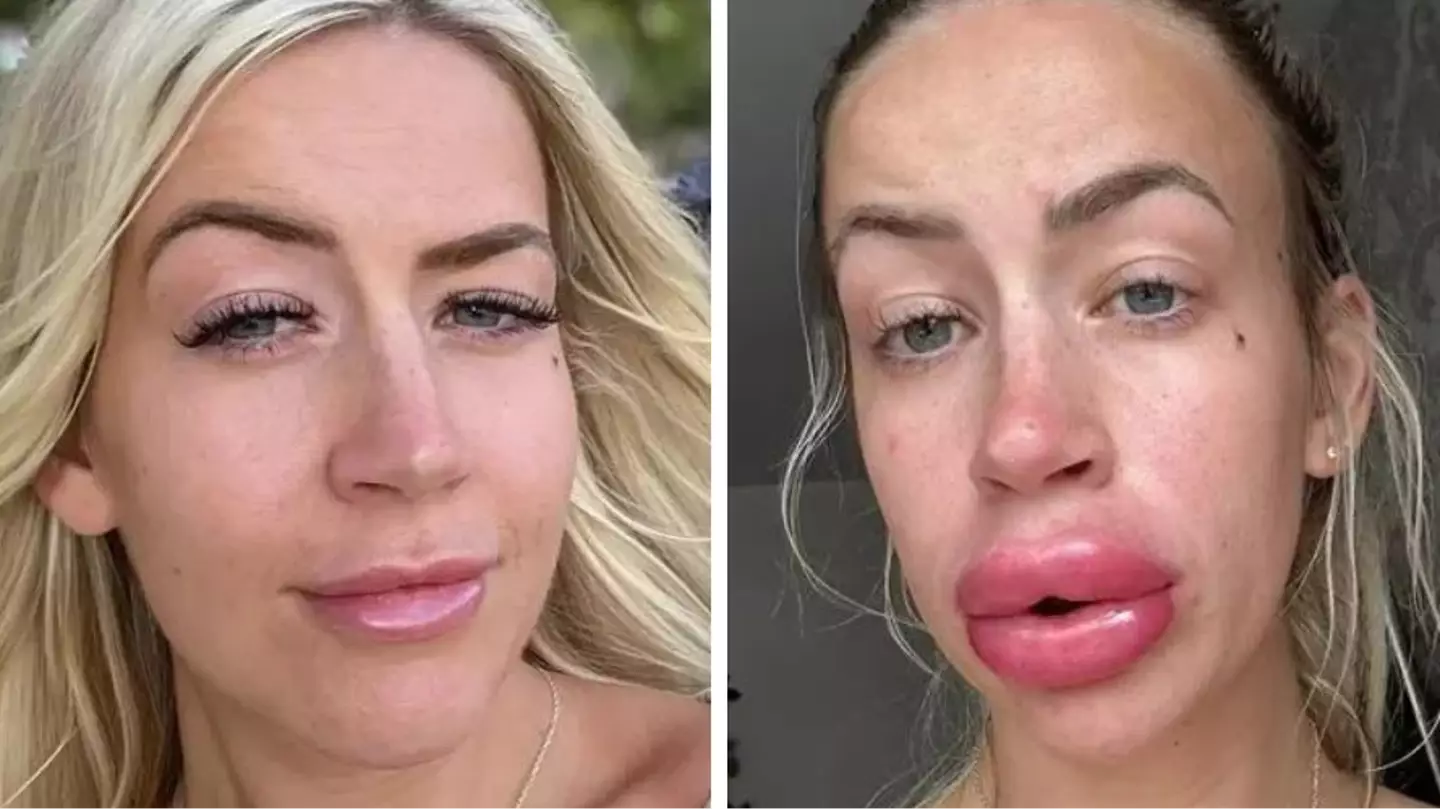 Woman's lips go from bad to worse after getting filler dissolved
