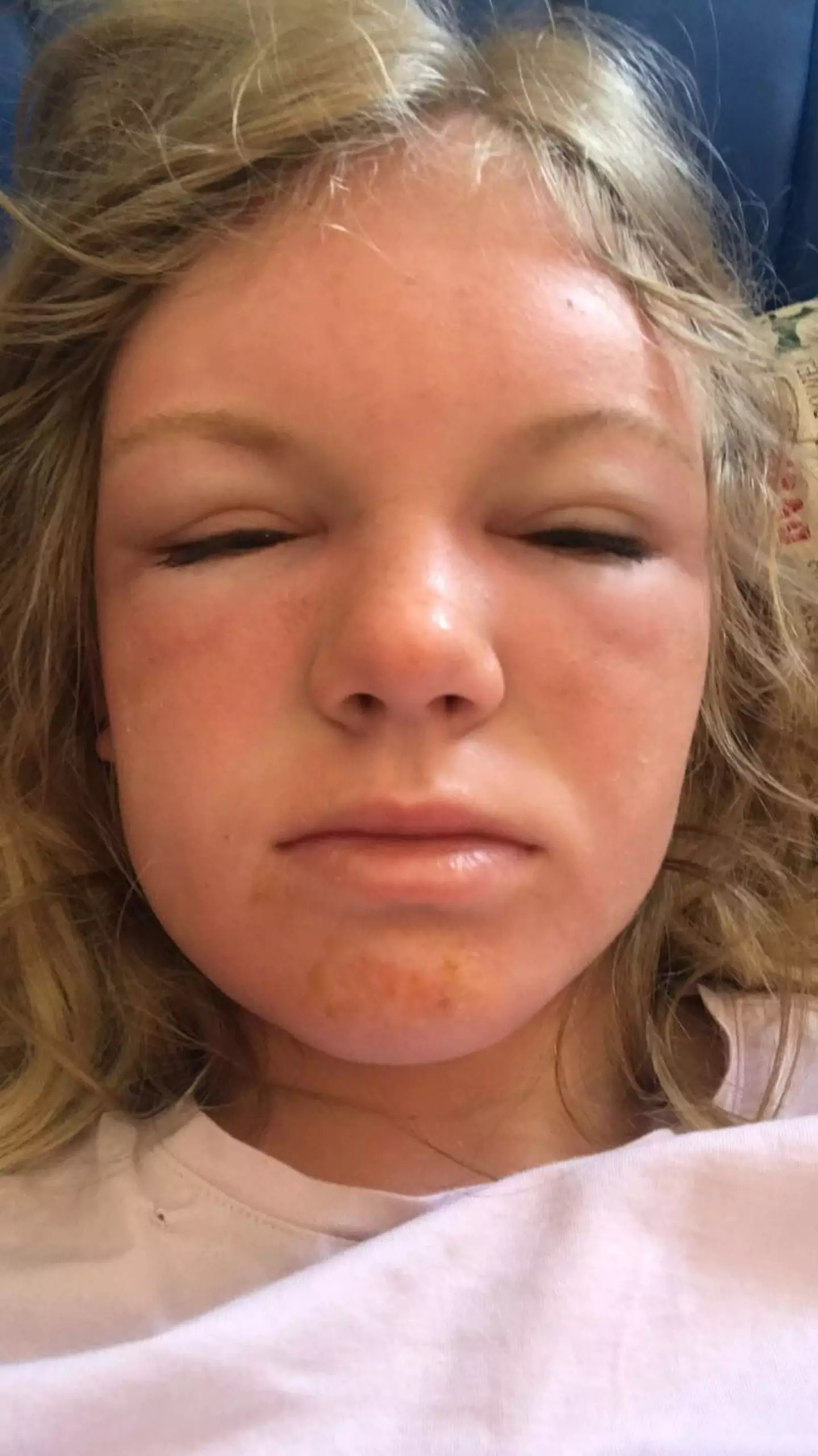 Her face became painful and swollen.