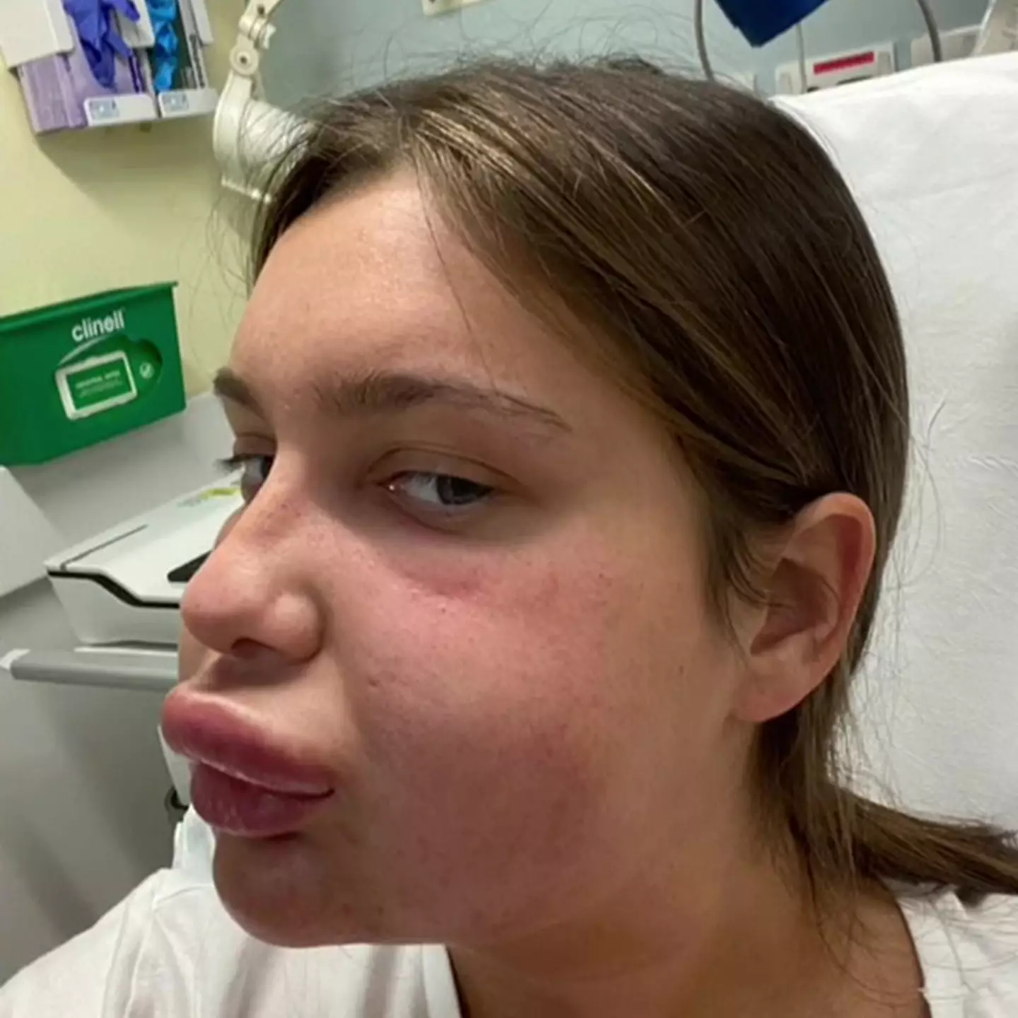 "I had my lip filler dissolved....and ended up in hospital."