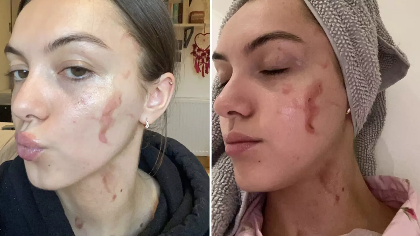 Woman scarred for life after claiming spaghetti hoops ‘exploded’ in her face