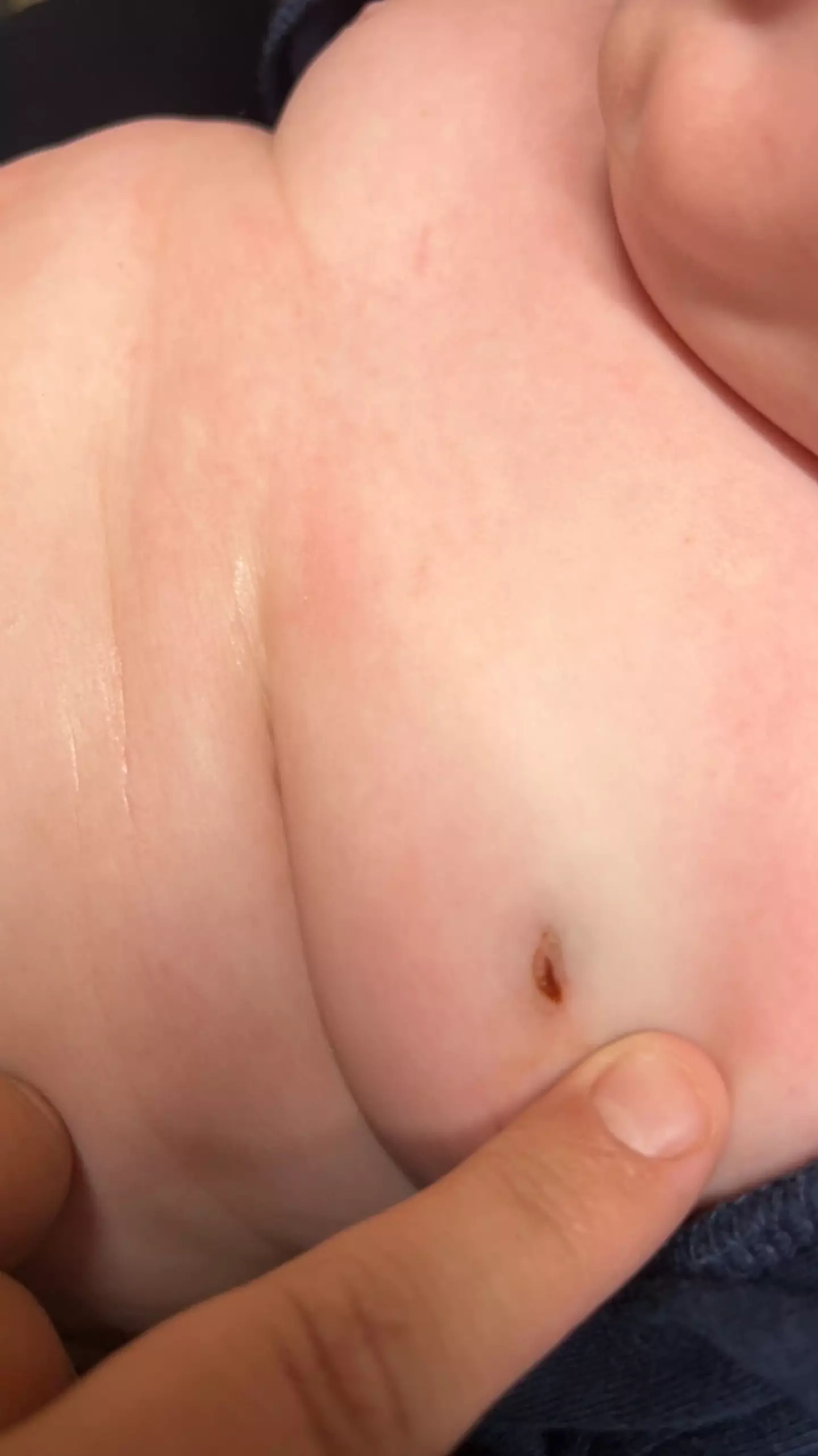 Doctors had to 'drain the poison’ out of little Bentley’s body.