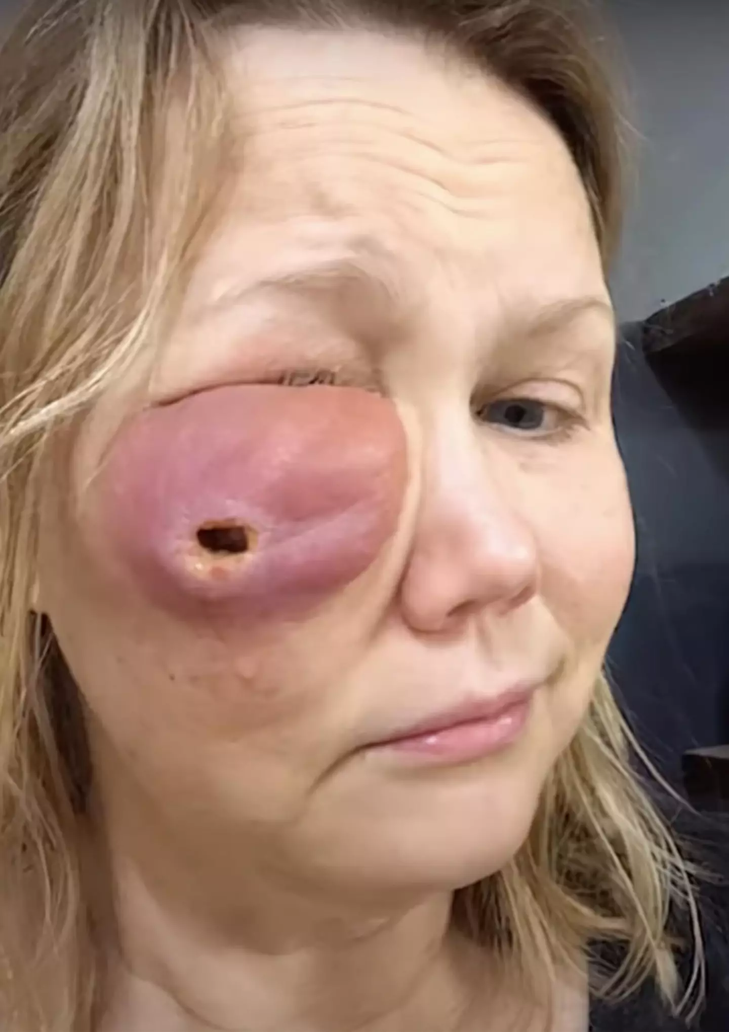 Gina Anderson was left with a painful hole in her face after a cosmetic procedure went wrong.