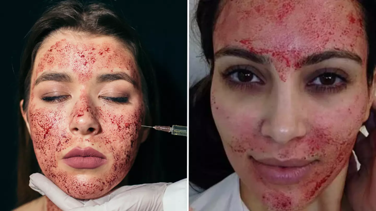Three women diagnosed with HIV after having celebrity-loved ‘vampire facial’
