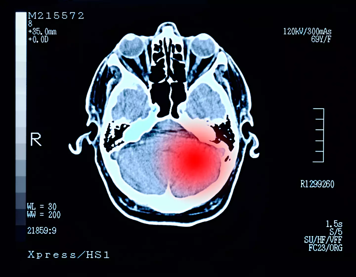 The symptoms of a benign brain tumour can be 'subtle'. (Getty Stock Images)