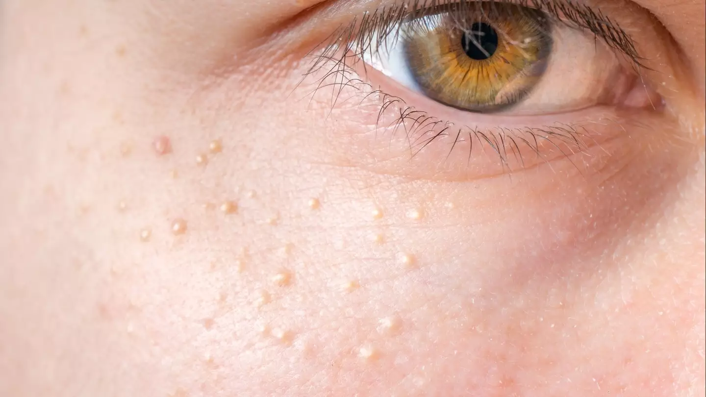 What those strange white bumps on your body actually are as private parts can be most affected
