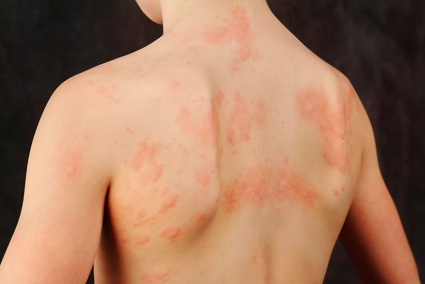 Rashes can be a tell-tale sign of Strep A.