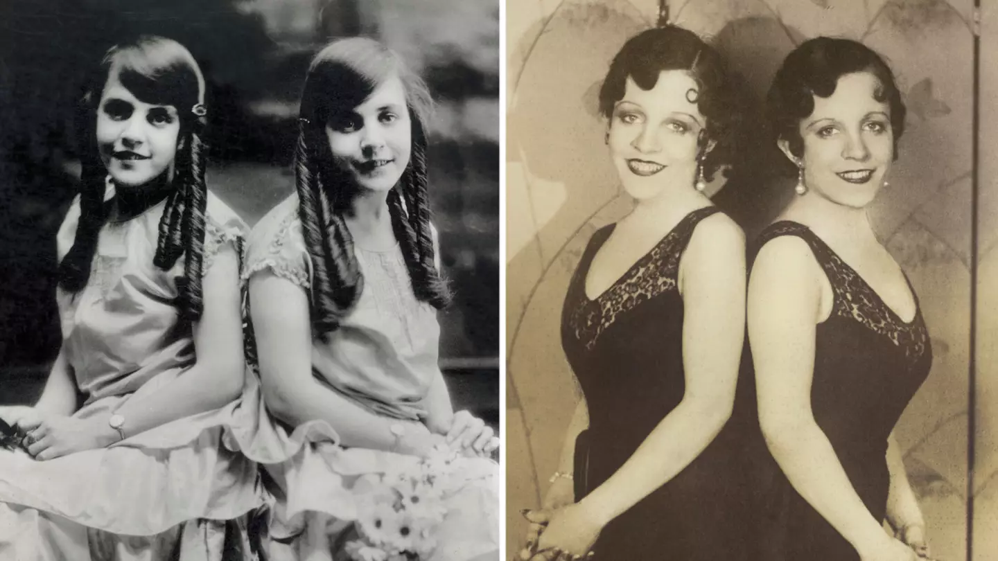 Disturbing case of conjoined twin who was forced to live with dead sister attached to her