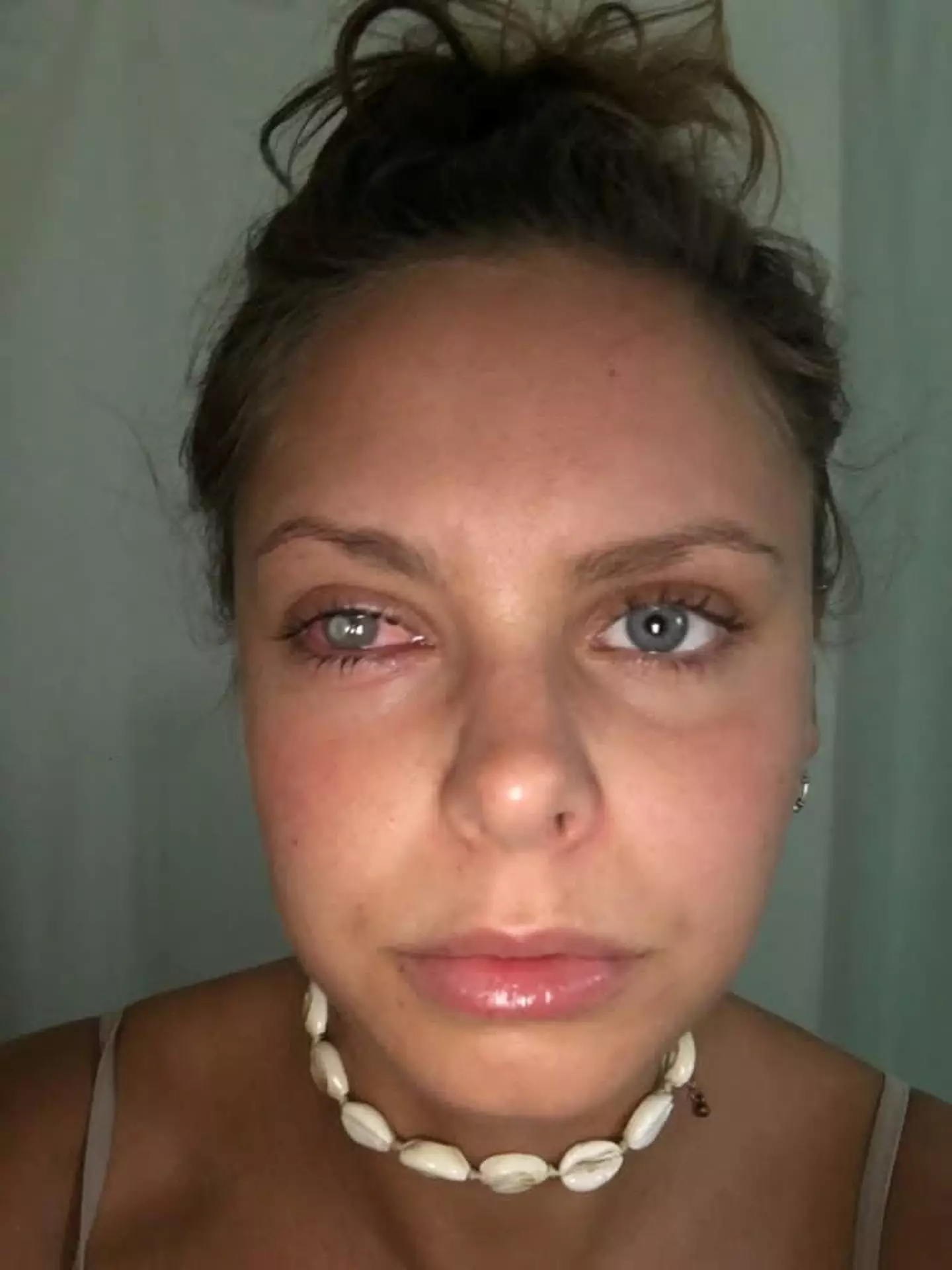 Laura's infection prevented her eye from opening.