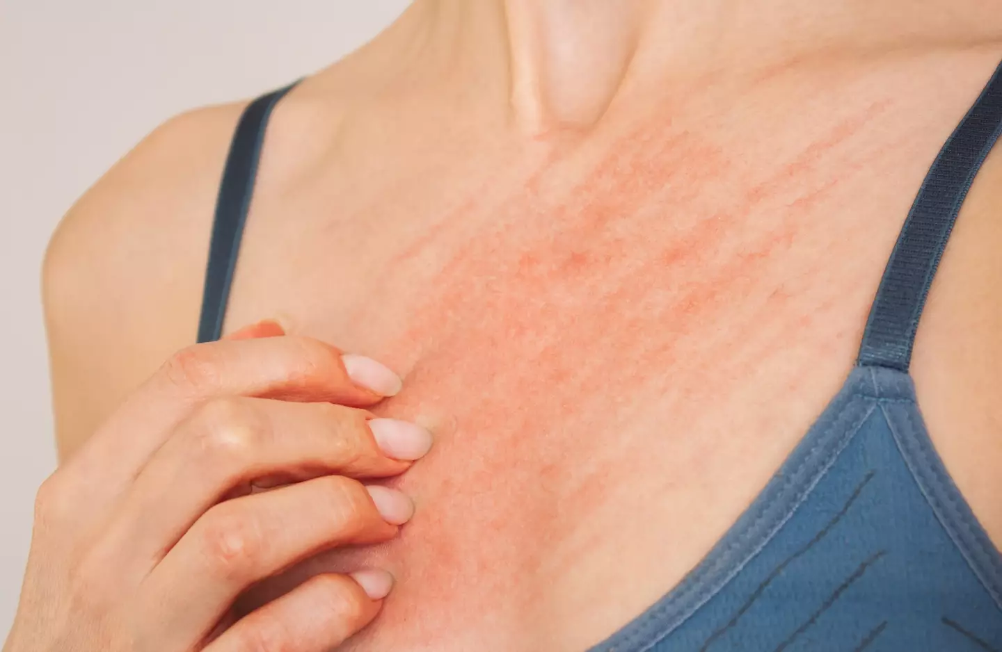 An itchy rash is the main symptom.