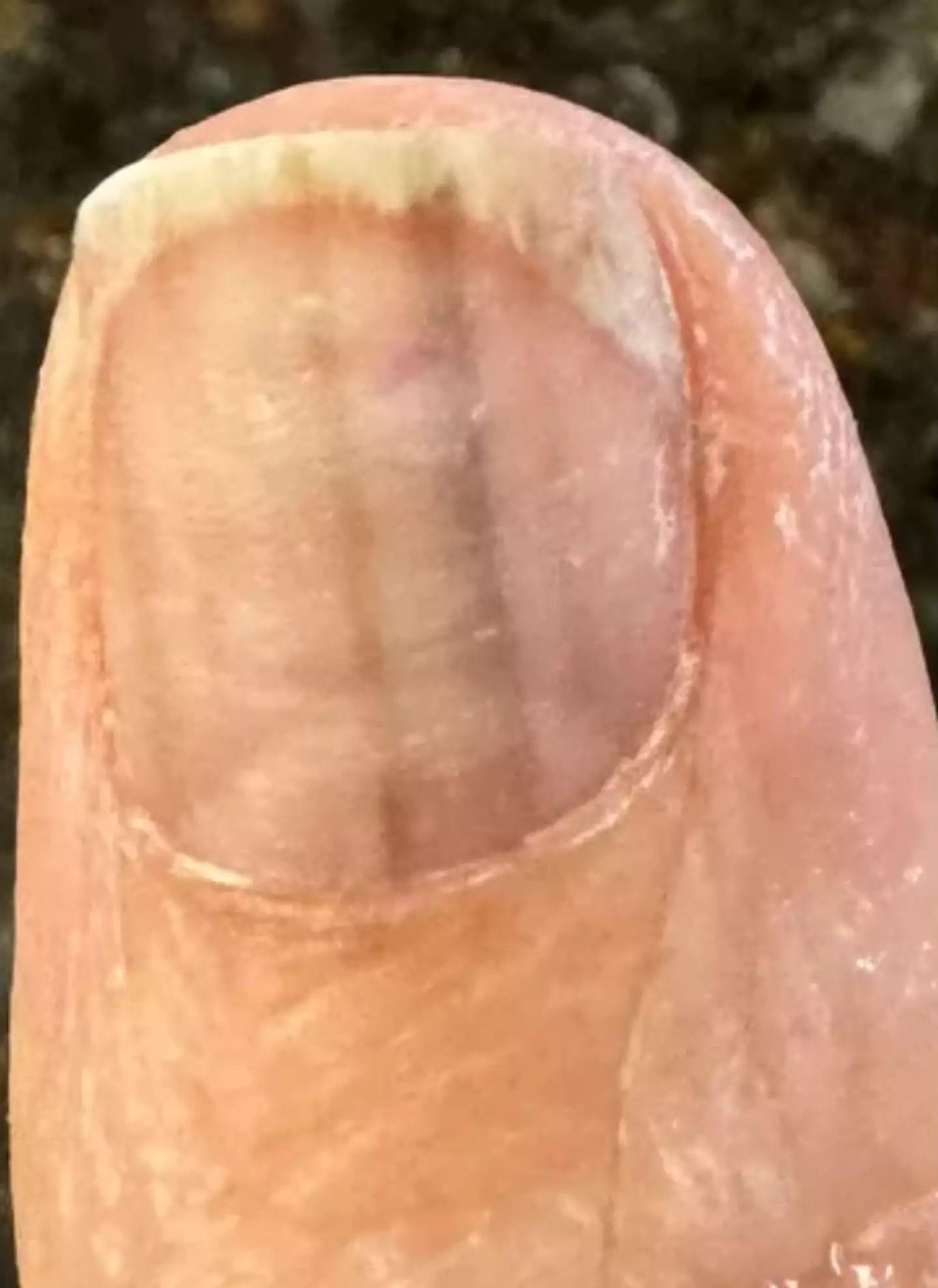The Ohio mum noticed black lines under her thumb nail (Kennedy News and Media)