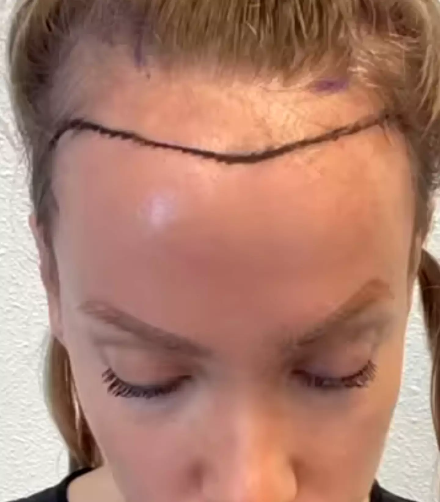 Sonja was insecure about her forehead before the transplant.
