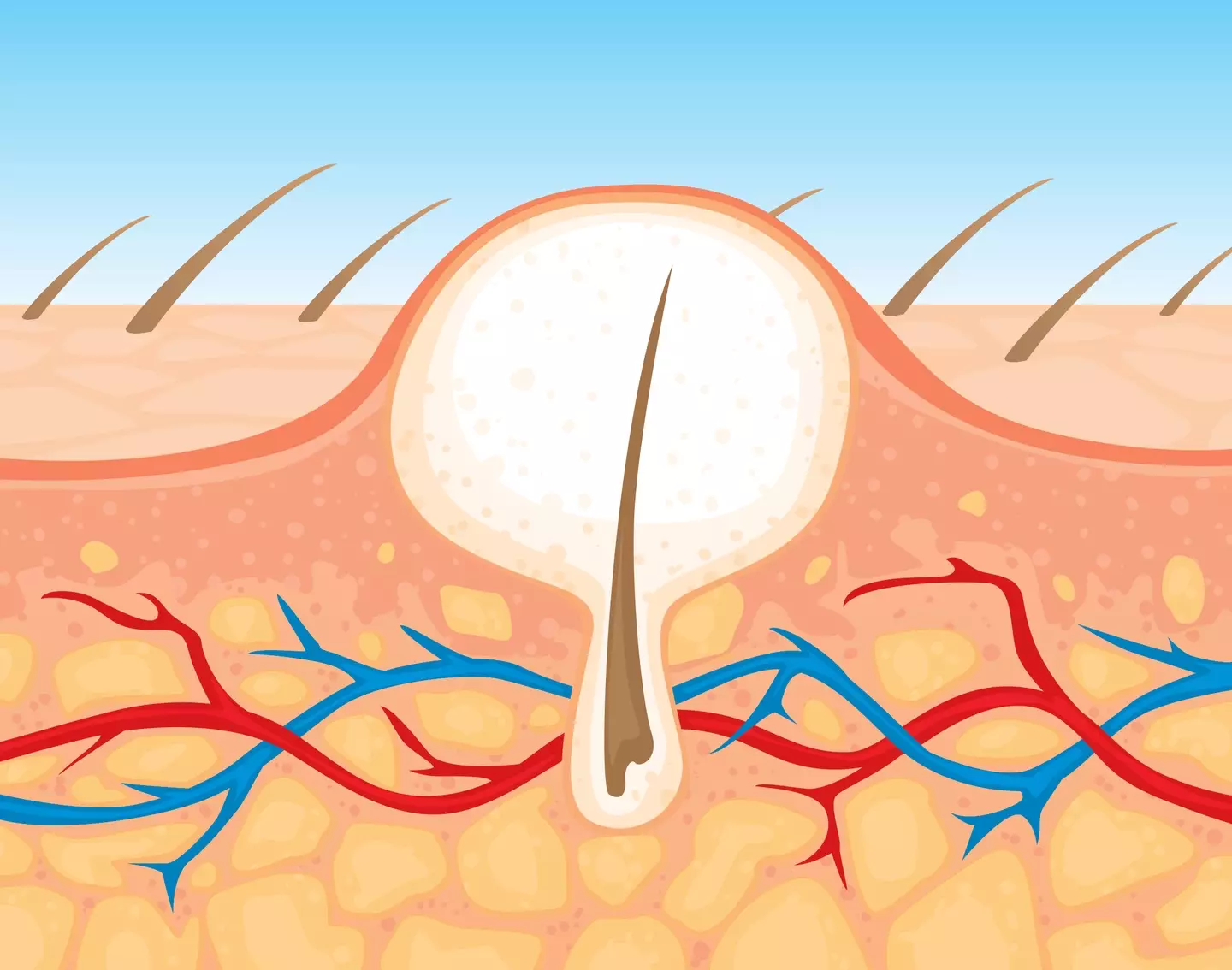 Ingrown hairs occur when the hair becomes trapped underneath the skin but proceeds to grow.