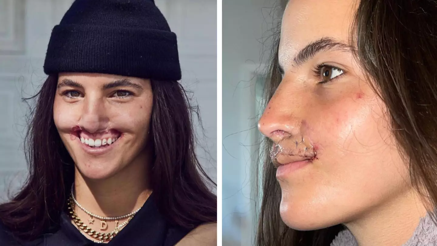 Woman whose lip was ripped off by pit bull shows off results of final reconstruction surgery