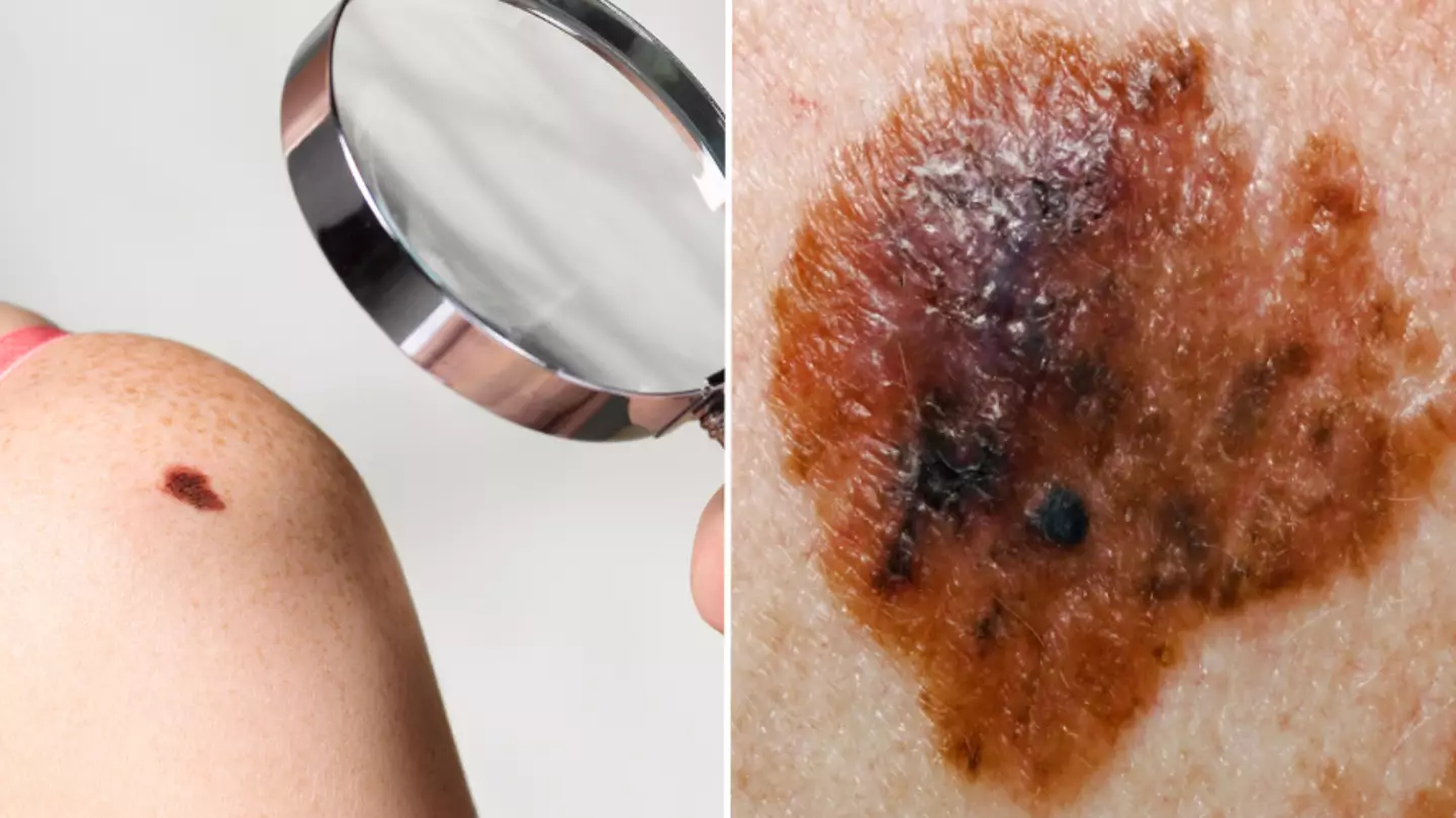 NHS advice on when to see a GP about skin cancer concerns as cases rise
