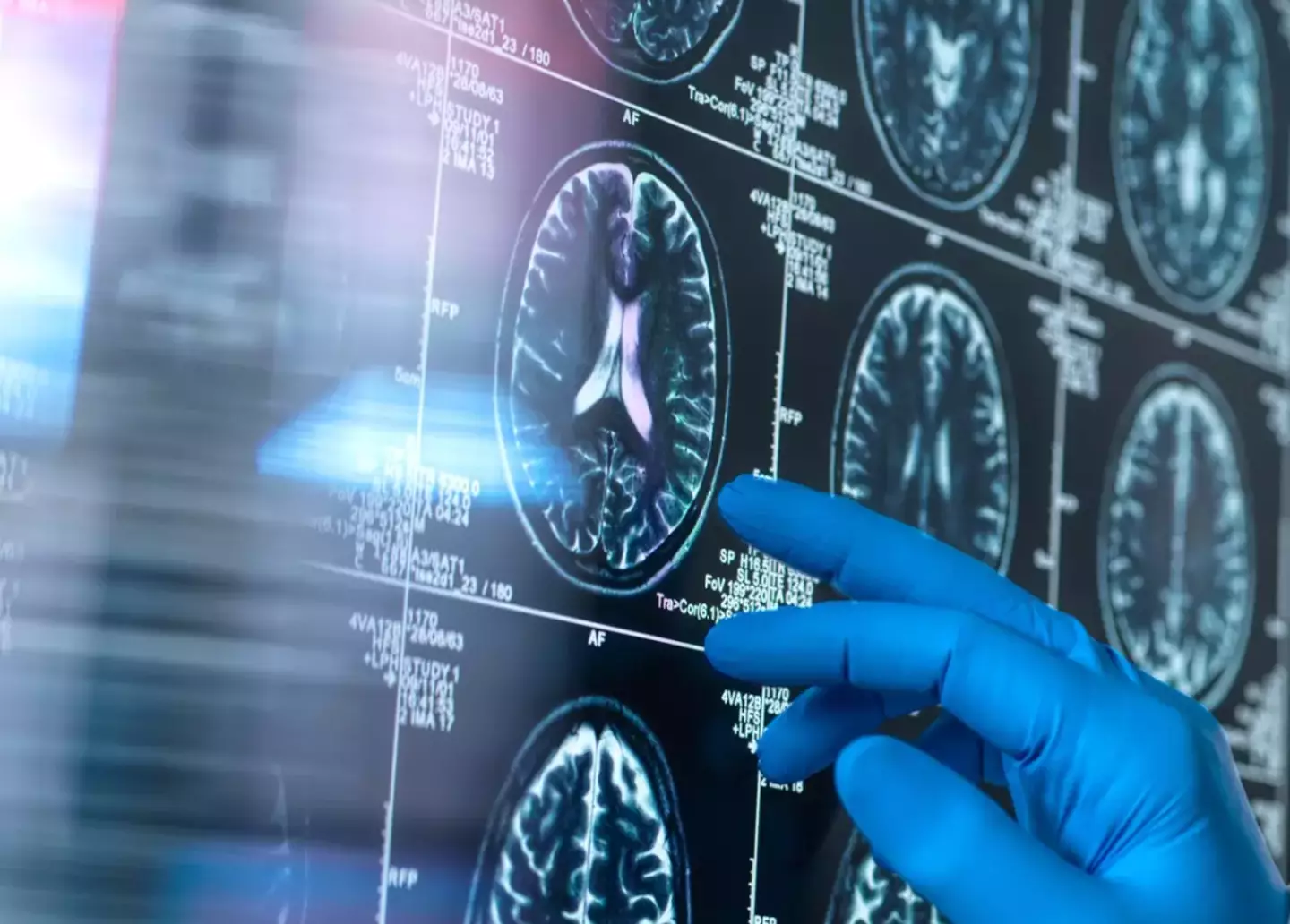 People living with dementia often have issues with sleep (Getty Stock Image)