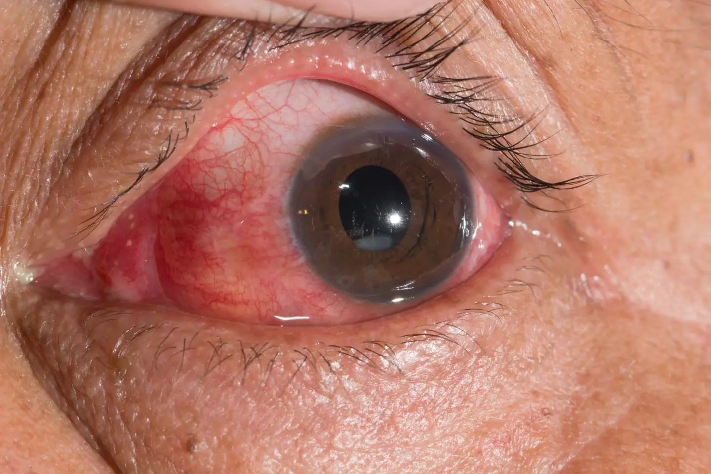 Cataracts occur when the lens of the eye develops cloudy patches (Getty Stock Images)