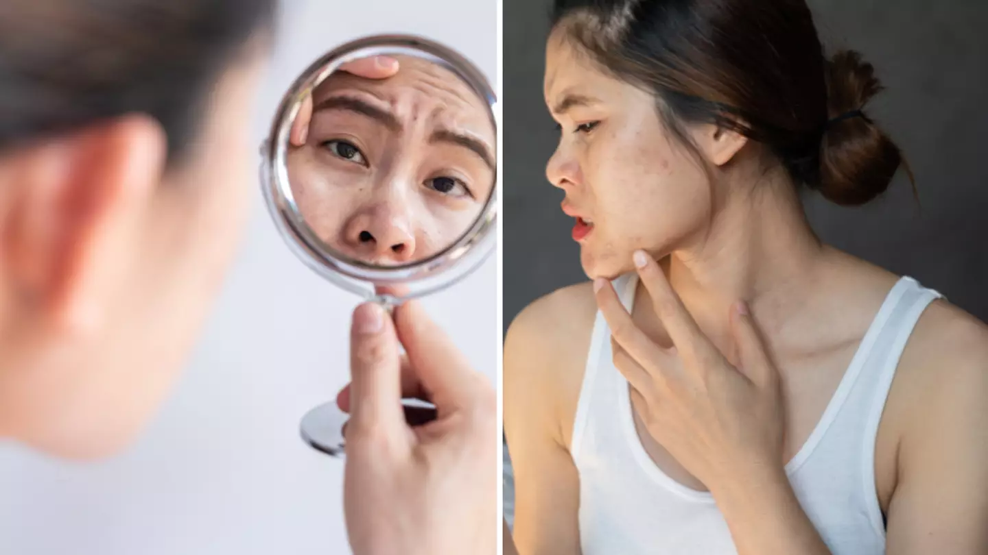 What ‘cortisol face’ really is as doctor warns to seek advice on symptoms