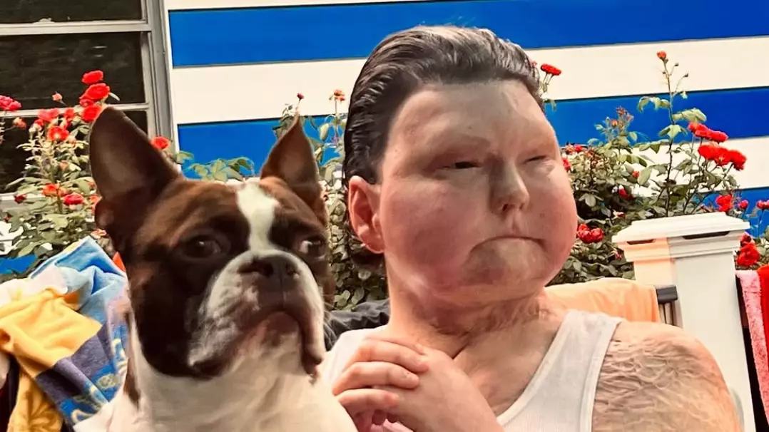 Man who received 47-year-old’s face in major transplant reveals unshared details about coma dreams