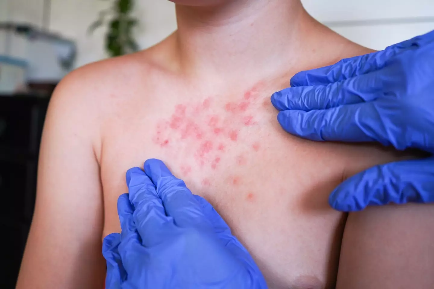 The biggest clue is intense itching, especially at night and a raised rash or spots (Getty Stock Image)