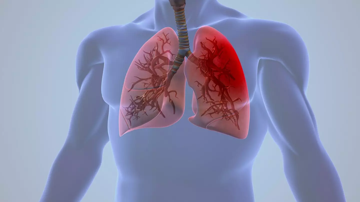 Pleurisy is inflammation around the lungs (Getty Stock Images)