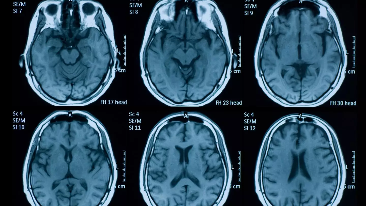 Long Covid linked to Alzheimer’s-like symptoms in people’s brains