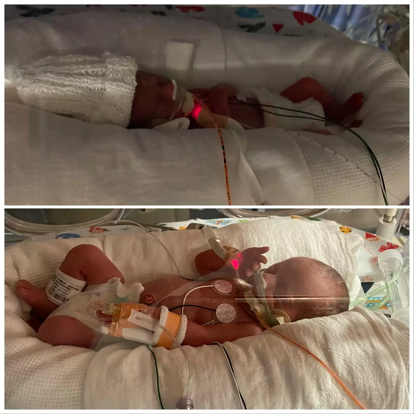 Both twins were born 11 weeks early.