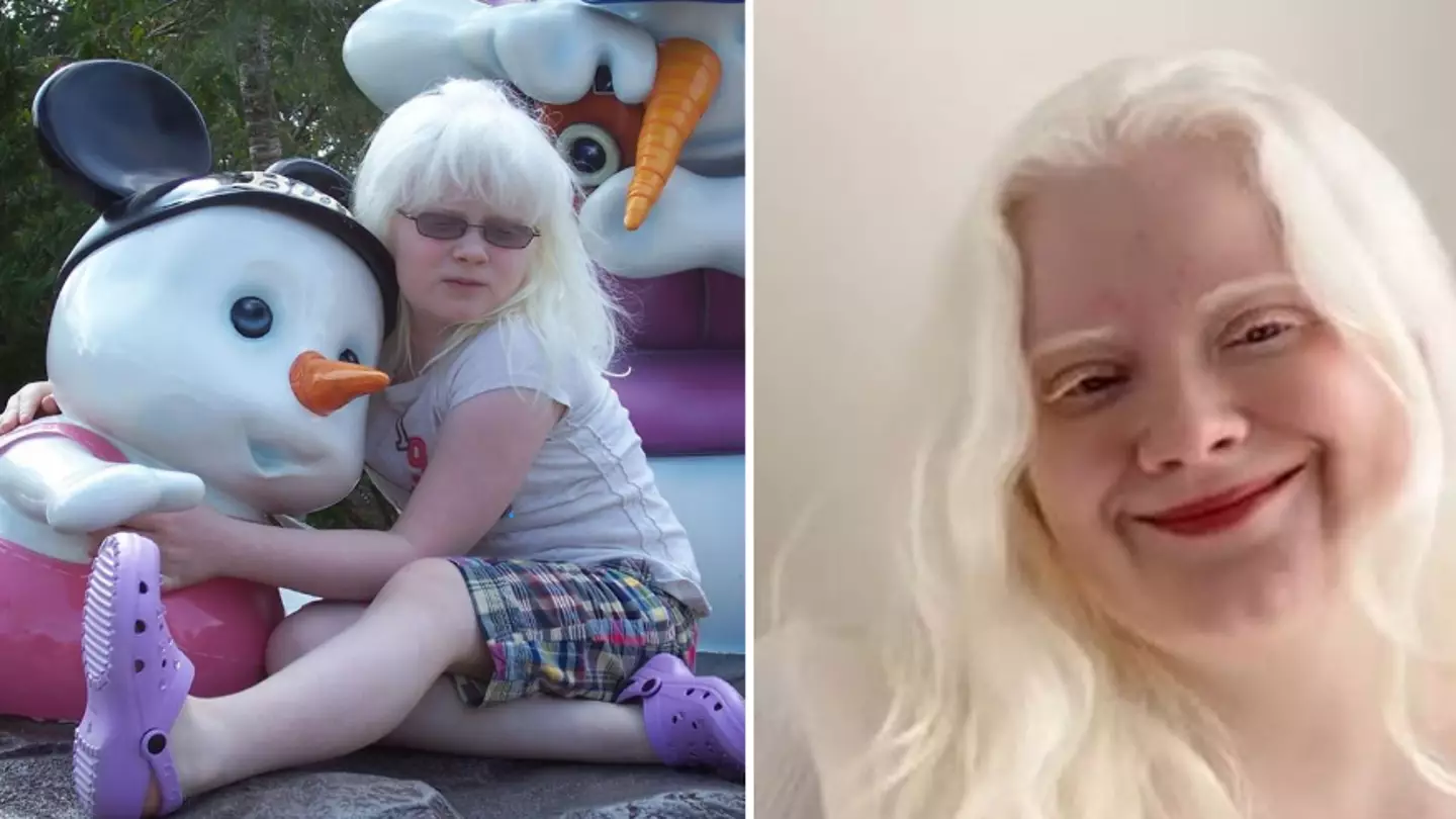 Albino woman cruelly called ‘ghost’ by bullies gives powerful message to others who feel ‘alone’