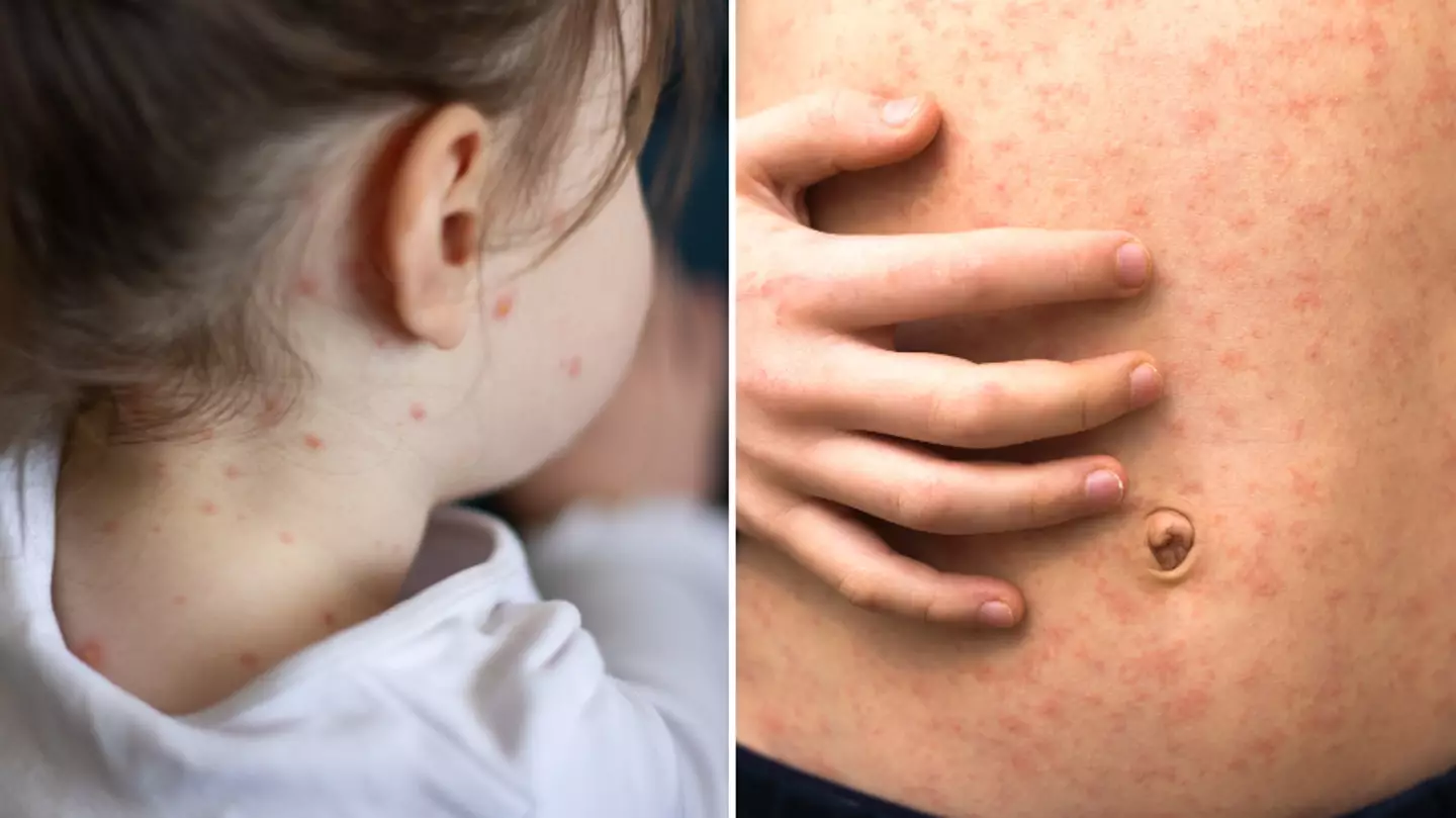 Measles symptoms to look out for after spike in UK cases