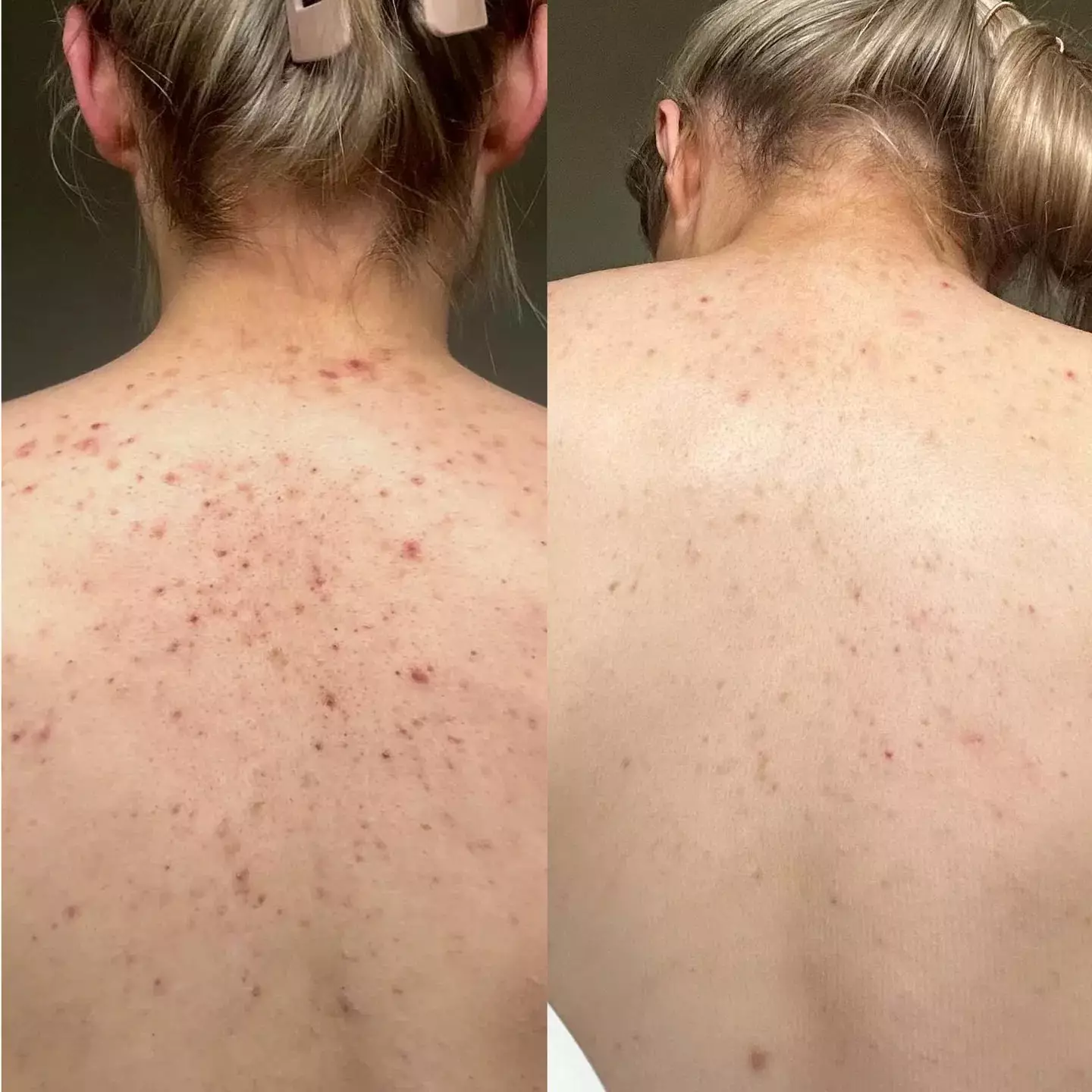 Customers say the body wash has 'reduced their back acne' (47 Skin)