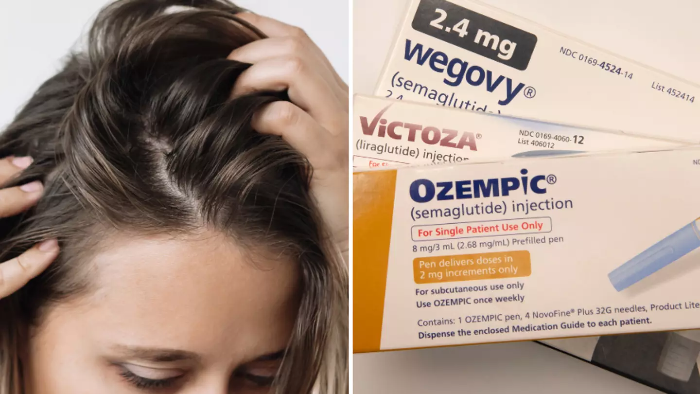 Doctors issue serious warning on 'Ozempic scalp' as people report extremely painful hair loss
