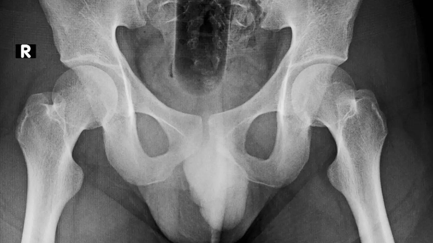 24-year-old man hospitalised after getting WWl bomb stuck up his bum