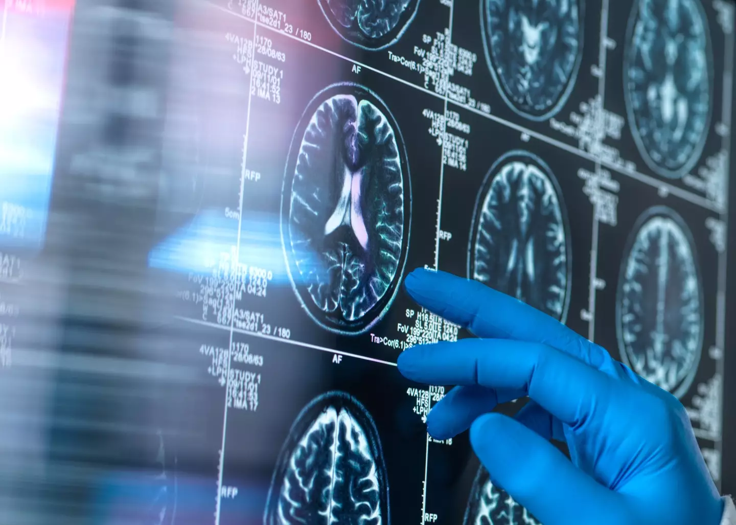 The virus responsible for cold sores may also be connected to Alzheimer's disease (Getty Stock Image)