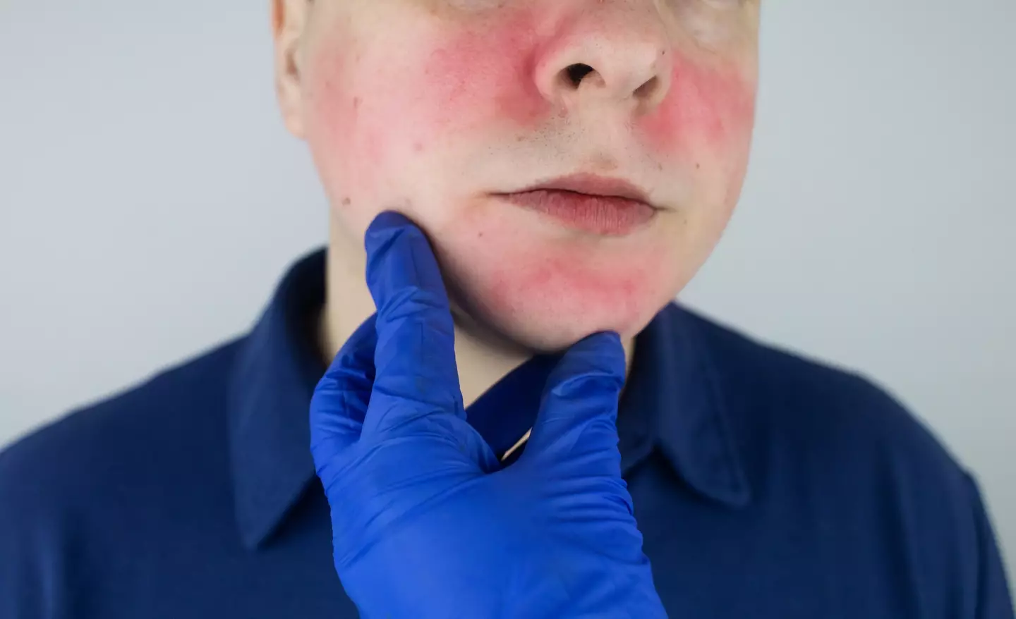 Facial flushing occurs in some drinkers (Getty Stock Image)