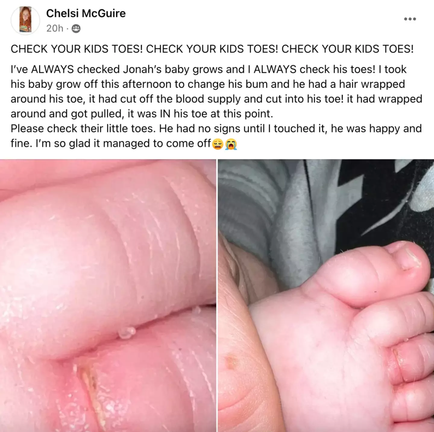 A stray hair cut off Chelsi's son's blood supply.