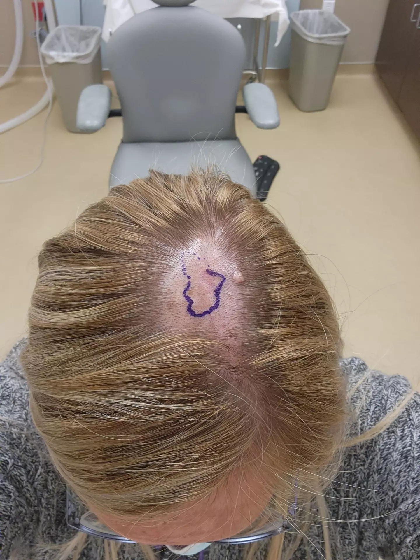A mum was left with a 'hole in her head' after needing a chunk of skin on her scalp removed.