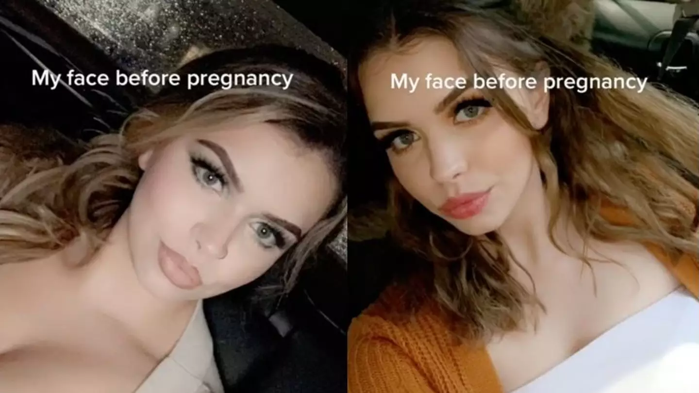 Woman Shares Her Face Before And After Pregnancy