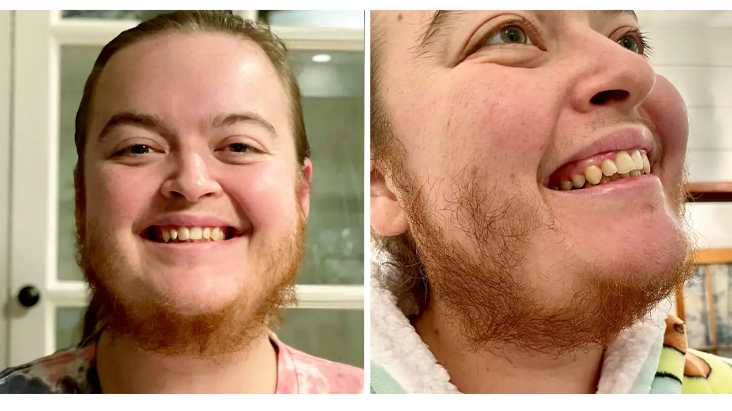 Woman Says She's 'Free' After Ditching Razor To Let Beard Grow