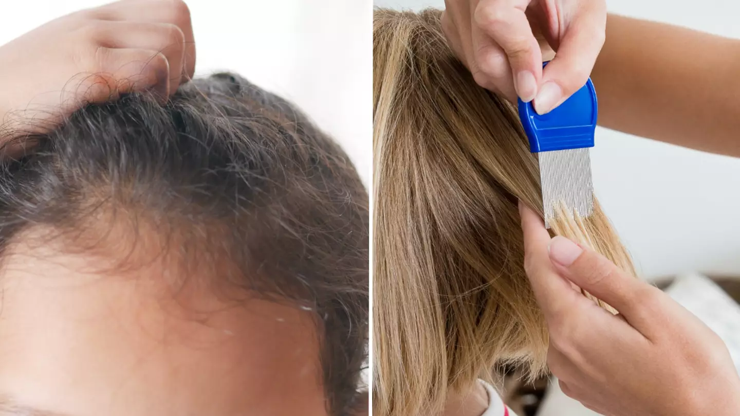 Expert warns against popular hack for getting rid of headlice