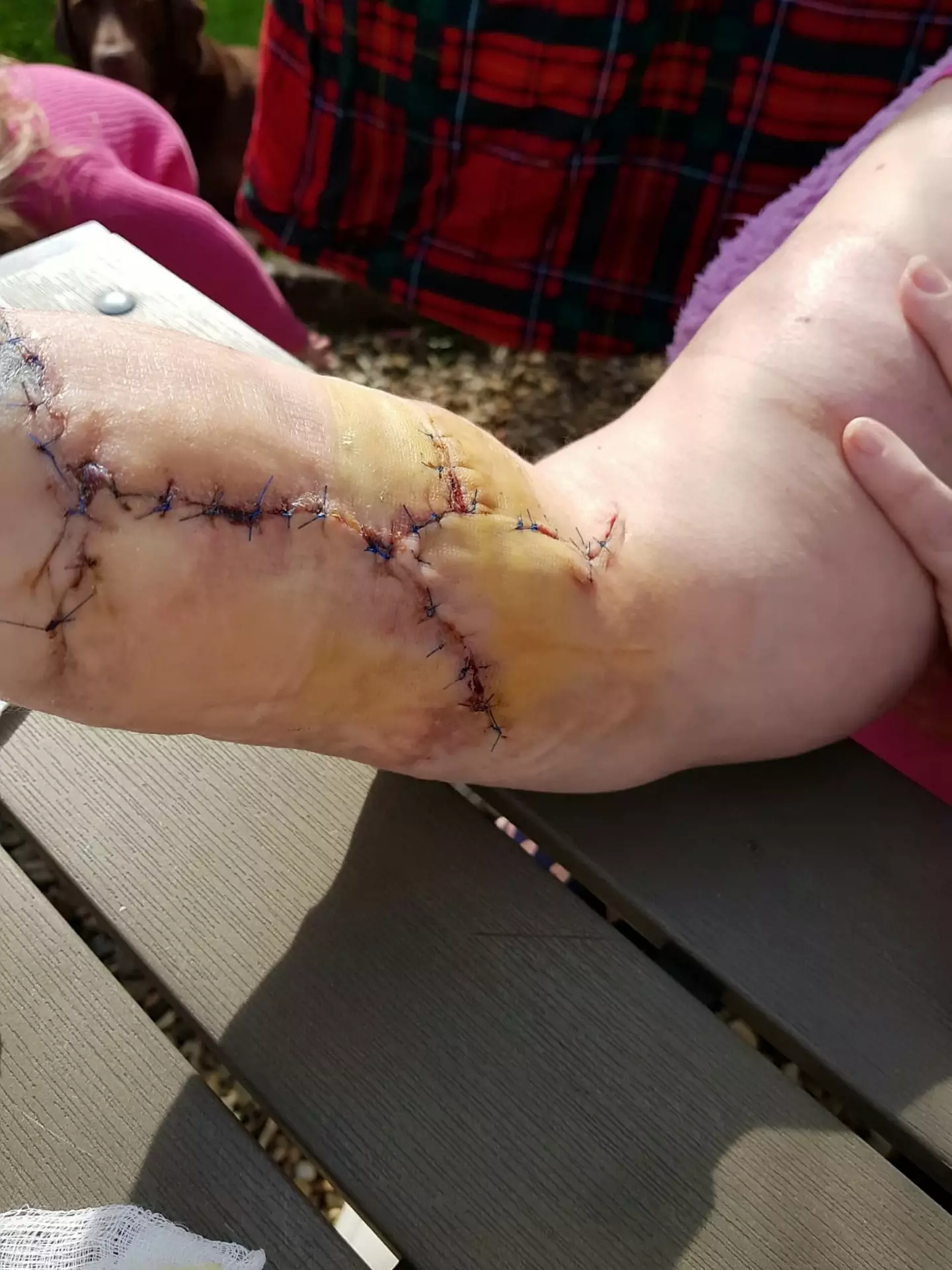 Anderson was attacked for 45 minutes.