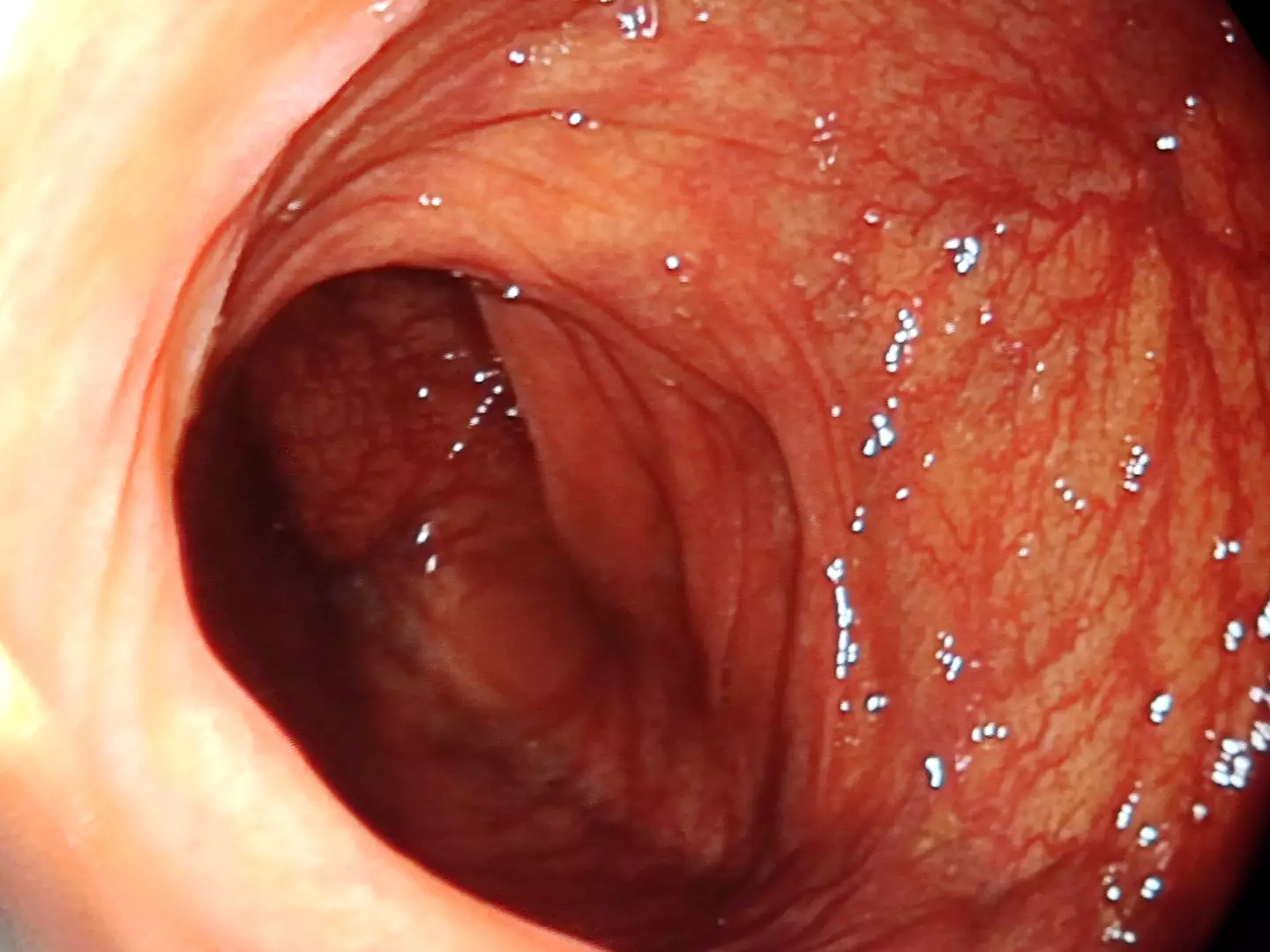 Doctors recommend we consume as little red meat as possible (Getty Stock Image)