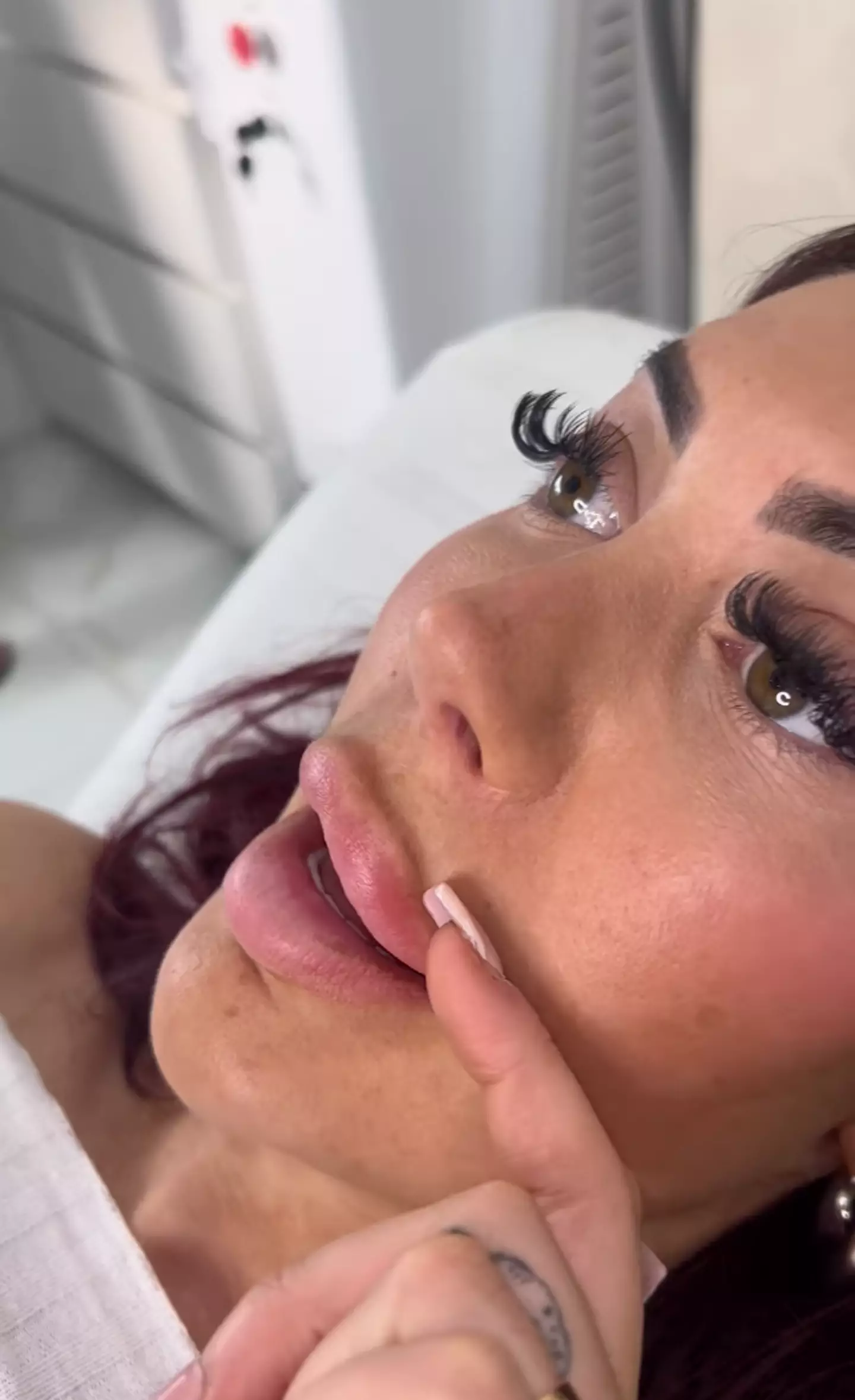 Chloe Ferry explained that her lip filler had 'migrated' to her top lip.