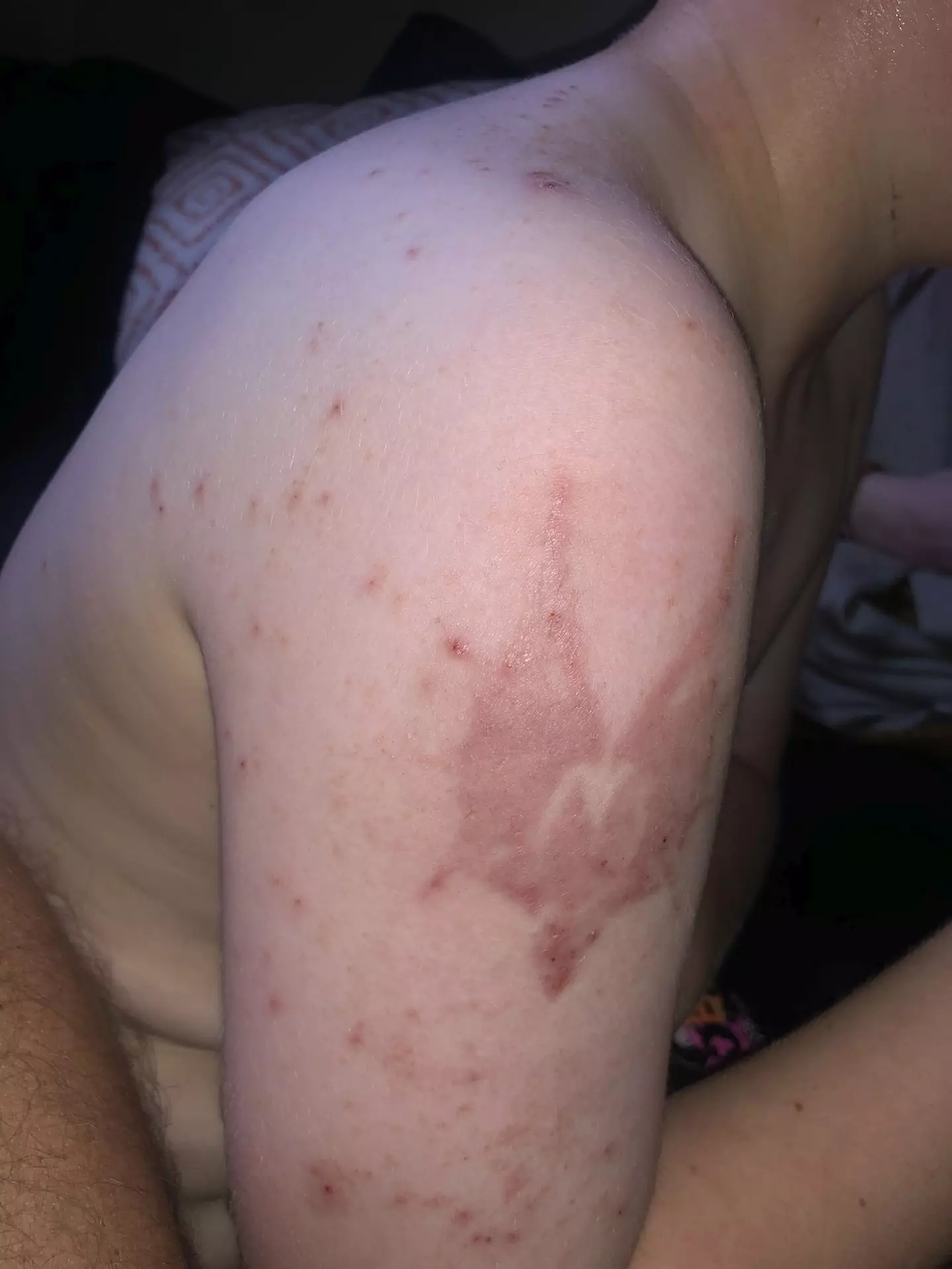 Caden has recovered but still has a scar.