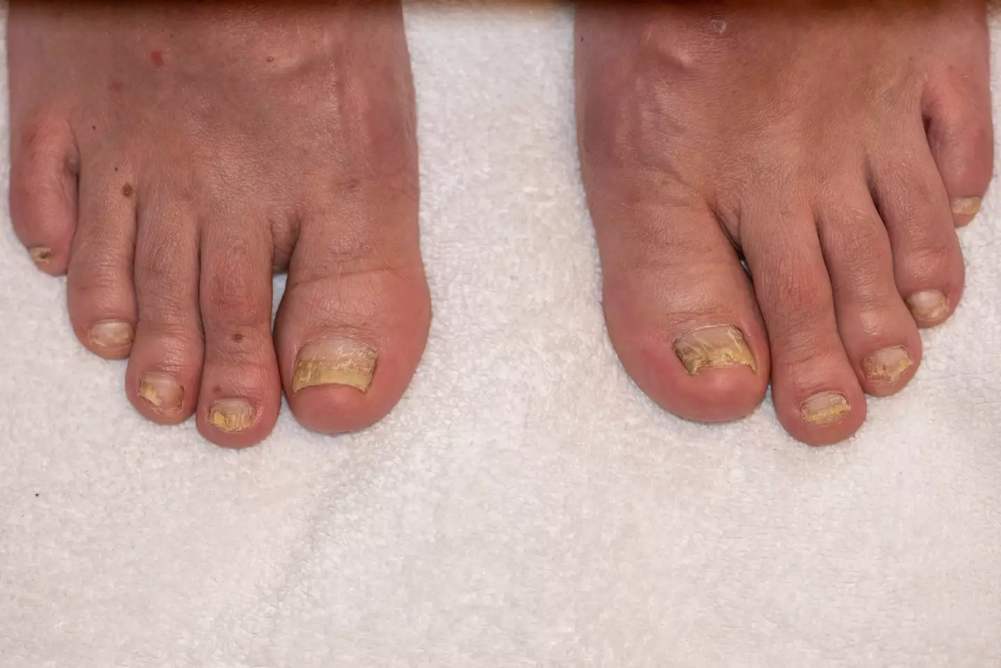 The condition could also cause a thickening or yellowing of the toenails (Getty Stock Image)